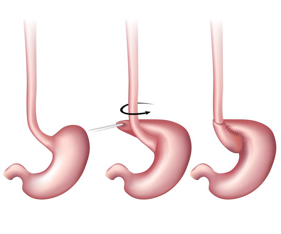 Das Ziel der Fundoplicatio liegt darin, aus einem Teil des Magens eine Art Manschette zu formen, die den unteren Schließmuskel der Speiseröhre verstärkt.